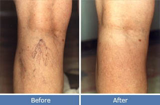 vein removal